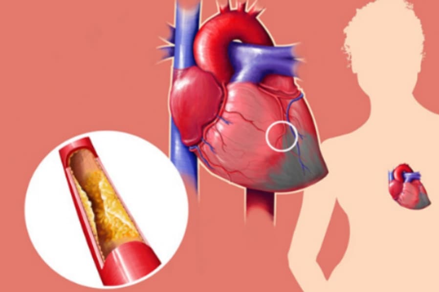 කොලෙස්ටරෝල් තියෙන අය අනිවාර්යයෙන්ම කියවන්න. මෙන්න ඒකට සුපිරිම බෙහෙත…