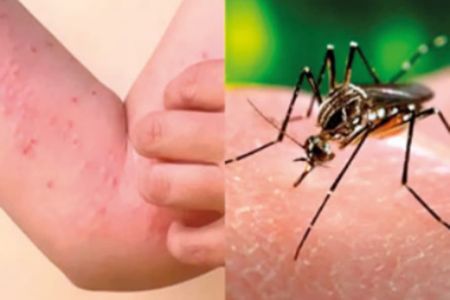 මේක නම් හදාගන්න එපා. හැදුනොත් මාස ගාණක් විඳවන්න වෙයි. චිකන්ගුන්යා ගැන කලින්ම දැනගන්න