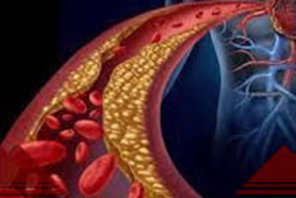 බොහෝ දෙනෙක් පීඩා විදින කොලෙස්ටරෝල් නැත්තටම නැති කරන බලගතු ස්වභාවික ඔසු හයක් මෙන්න